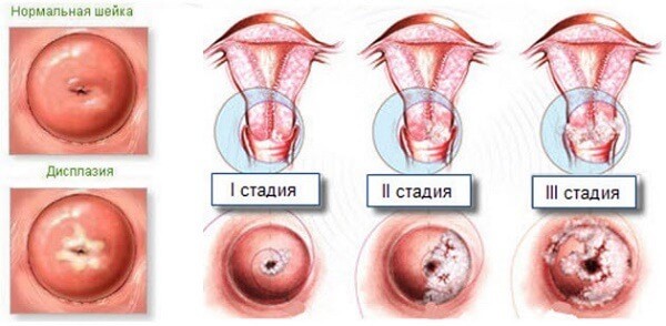 Дисплазия шейки матки 3 степени прогноз и беременность thumbnail
