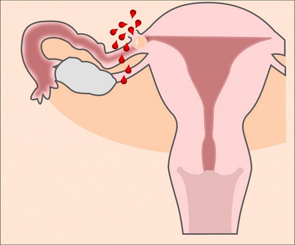 Температура и боли внизу живота у женщин при беременности thumbnail