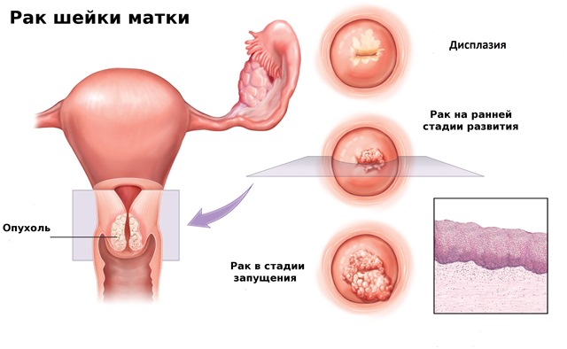 Что такое эрозия шейки матки и как она лечится?: статьи клиники Оксфорд Медикал Киев