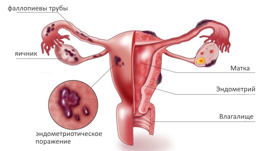 Эндометриоз генитальный