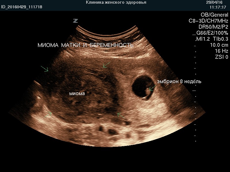 Как выглядит миома матки внутренняя на узи фото