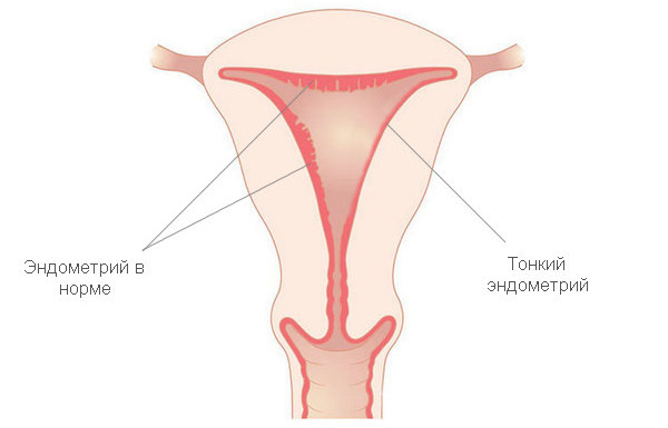 tonkij endometrij